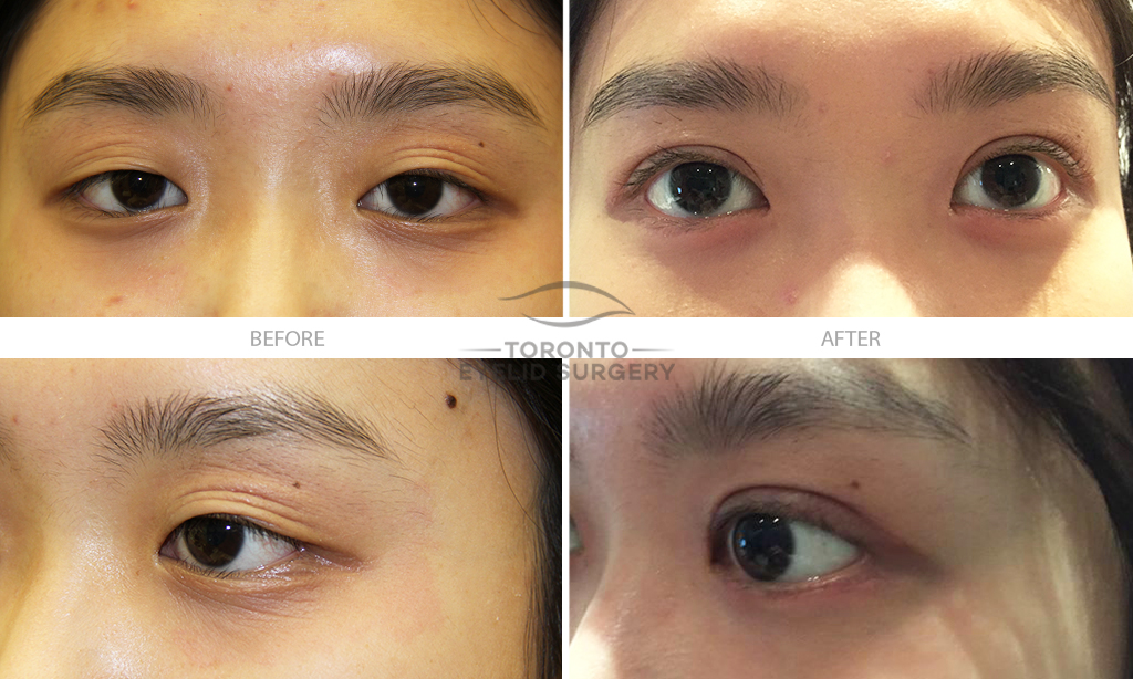 asian eyelid surgery before and after pictures